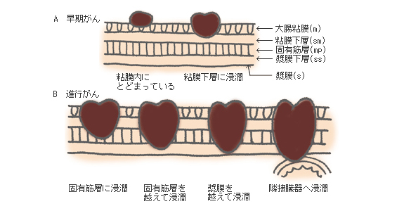 がんの浸潤度による早期・進行がんの分類