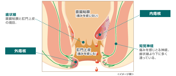 知っておきたい2つの痔核