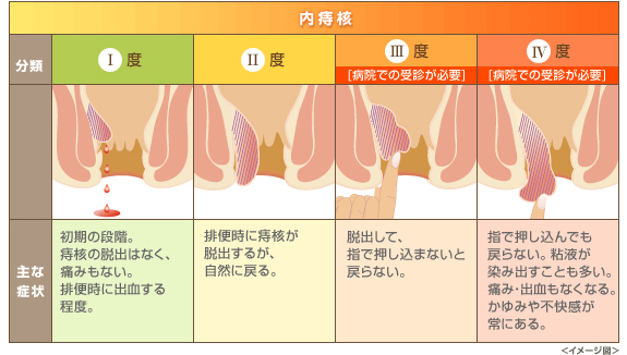 内痔核脱出の程度により、Ⅰ度～Ⅳ度に分類される