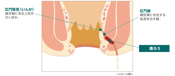 膿のトンネルができる痔ろう